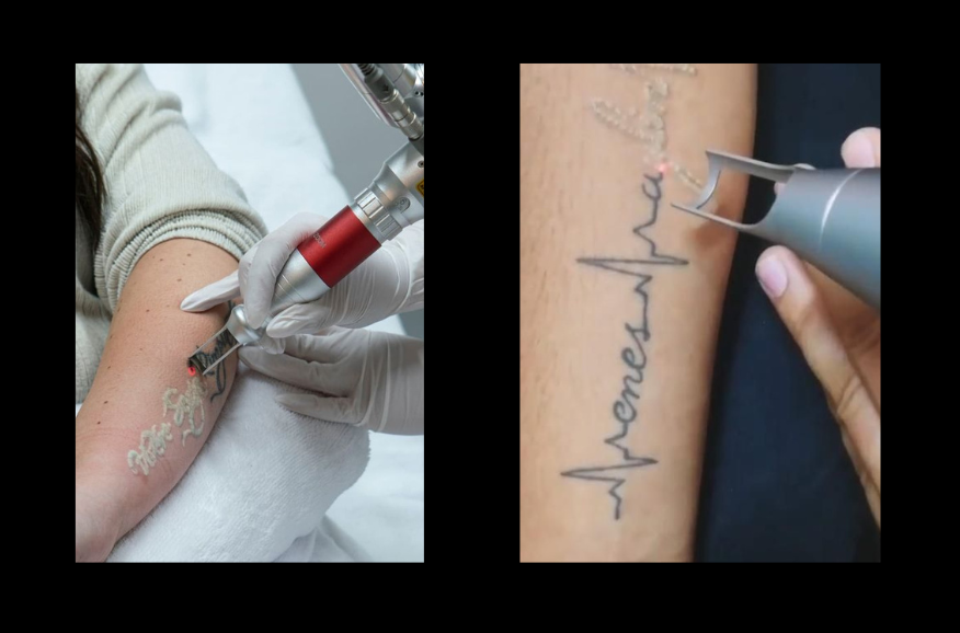 Tattoo Removal